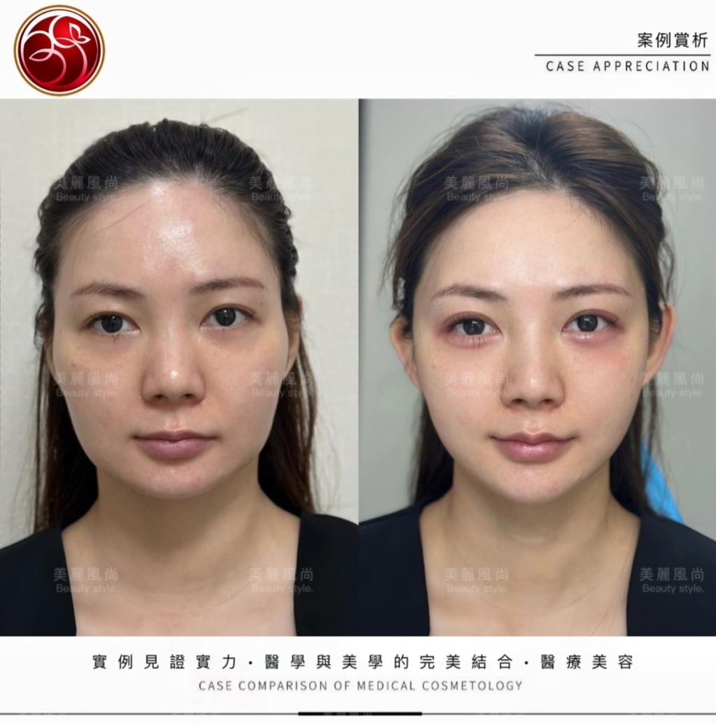 輪廓筋膜拉提