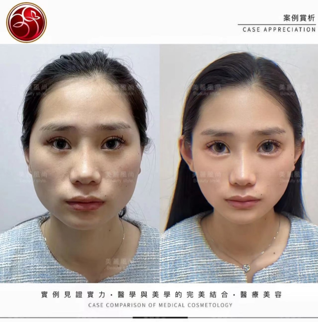 輪廓筋膜拉提