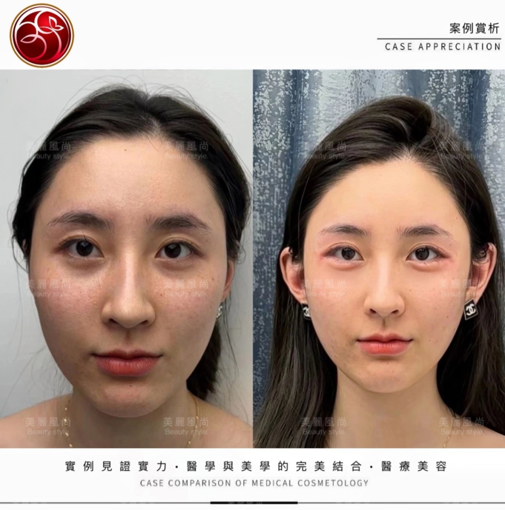 輪廓筋膜拉提