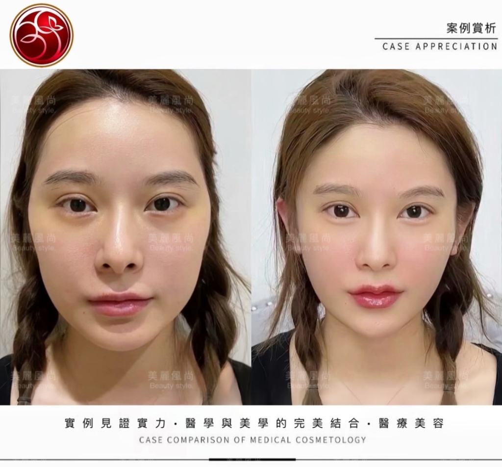 輪廓筋膜拉提